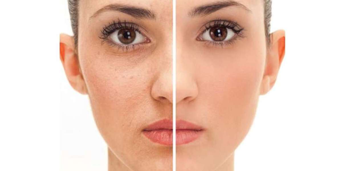 BB Skin Glow Treatment Nashville – Radiant Skin Care Solutions