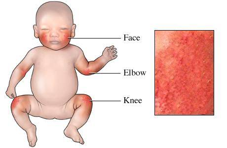 Eczema in Children: Causes, Treatments, and Daily Care | LogCla.com