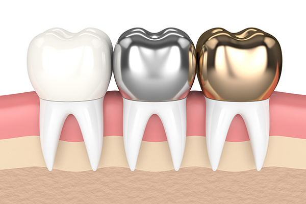 The Complete Guide to Dental Crowns: Restoring Strength and Confidence – BDnews55.com