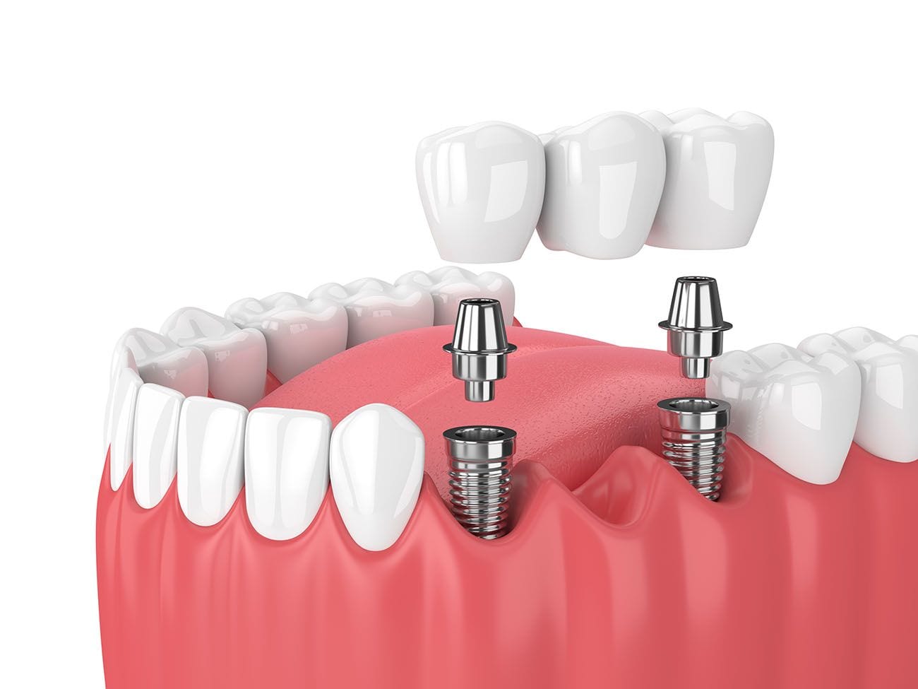 Why More Patients Are Choosing Dental Implants Over Other Restorations – BDnews55.com