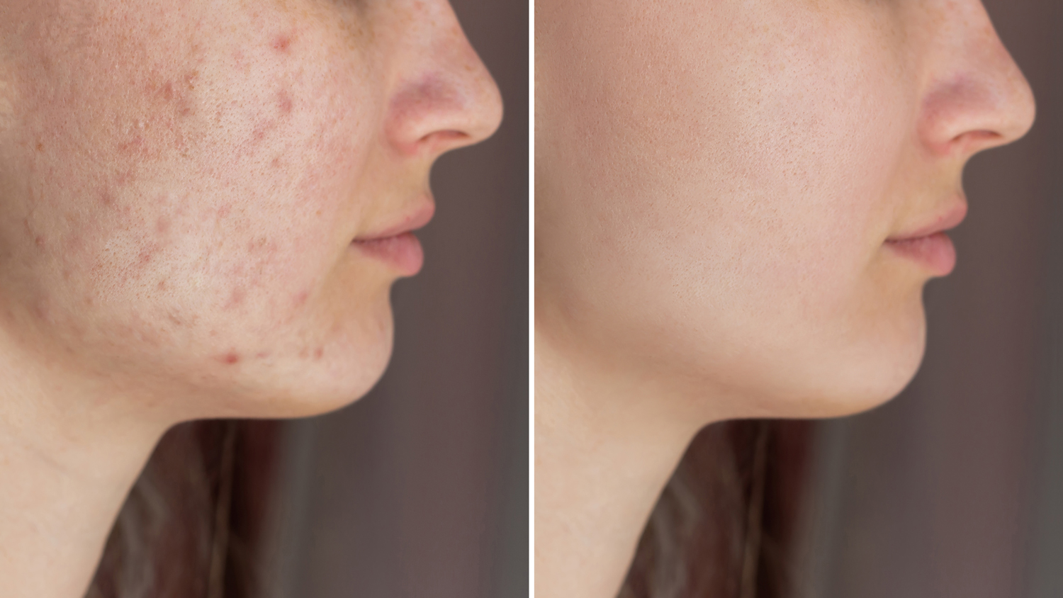 Acne Treatment | Dermatology Associates in Montana
