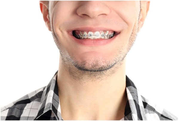 Forsus Spring Braces Miami | Metal Spring Braces Cost