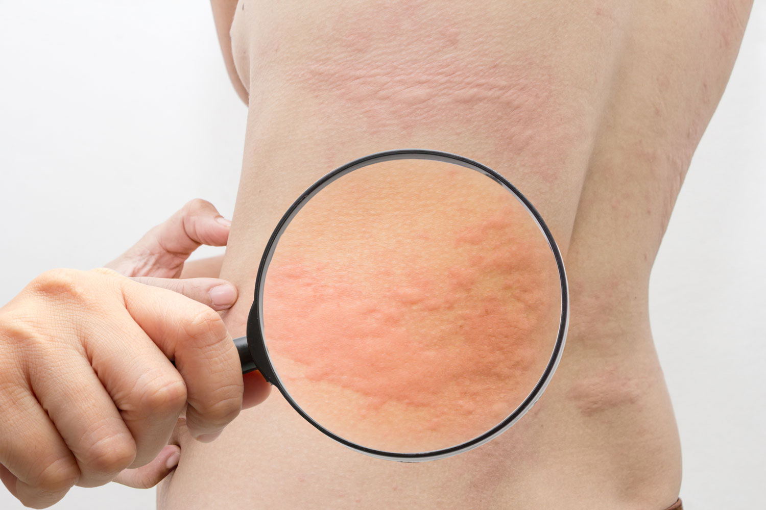 Hives Treatment | Dermatology Associates in Kalispell, MT