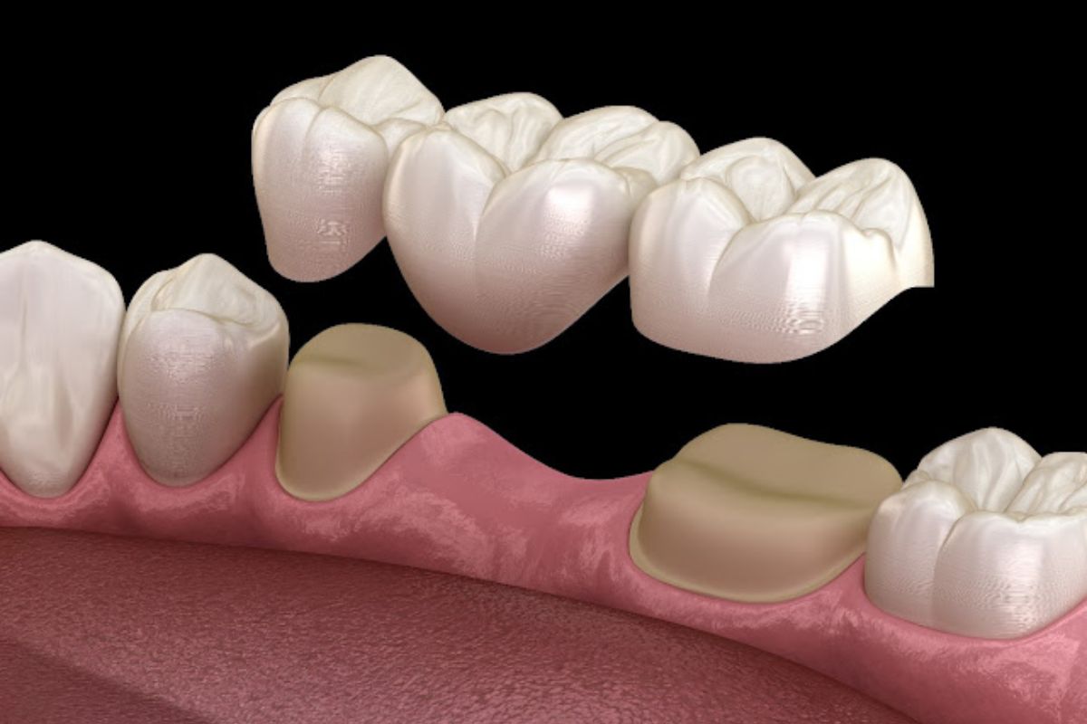 Restore Your Smile and Confidence with a Dental Bridge – BDnews55.com