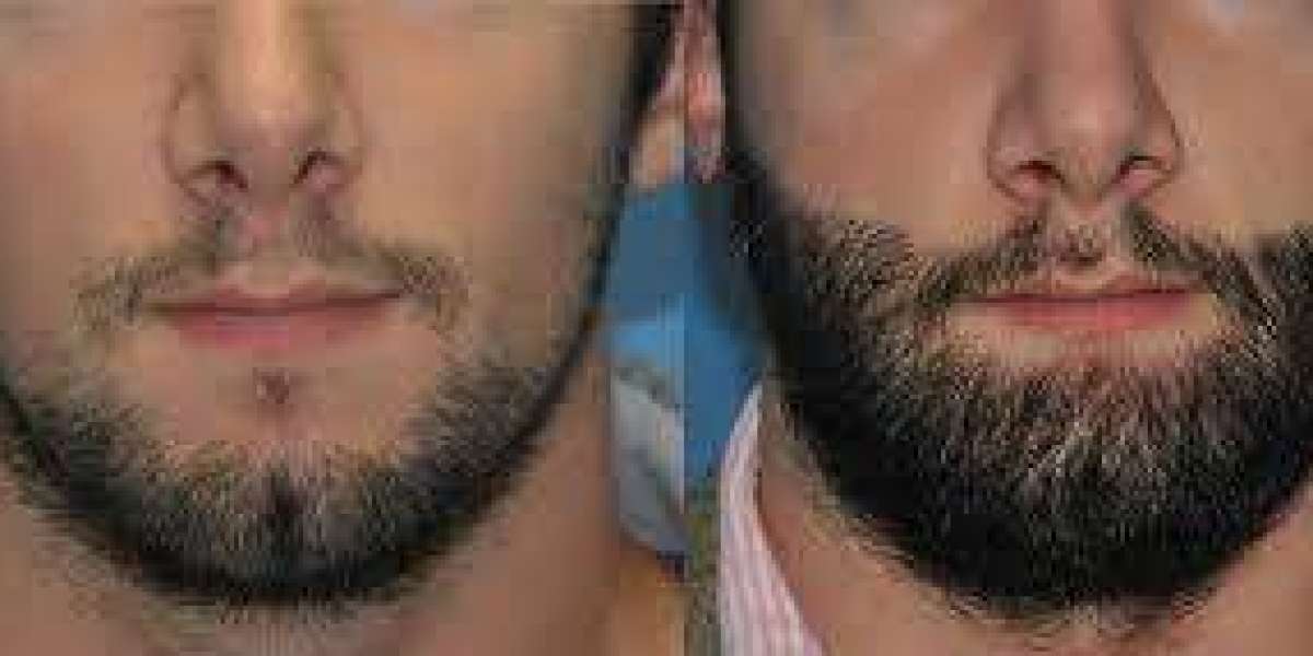 Why Beard Hair Transplants Are the Go-To Solution for Patchy Beards