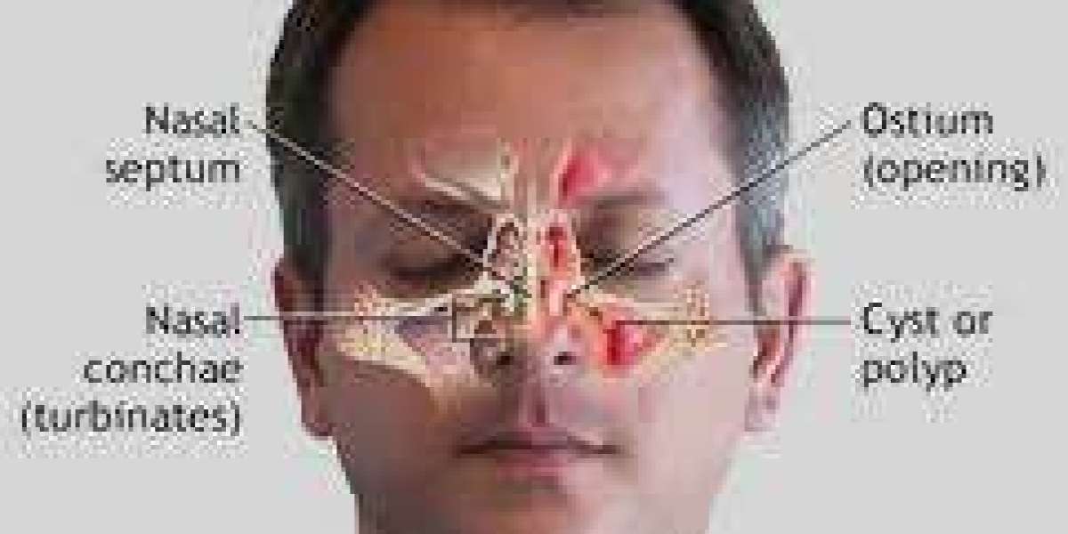 How Office Balloon Sinuplasty Los Angeles Helps Chronic Sinusitis Patients Avoid the Operating Room