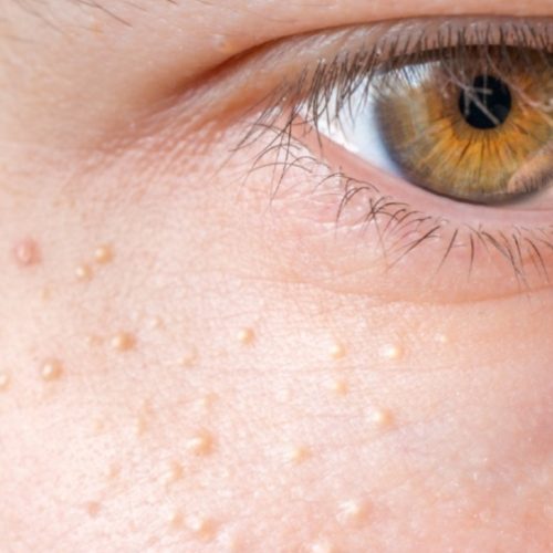 Milia Removal in Milton Keynes | Call at 770-383-0047