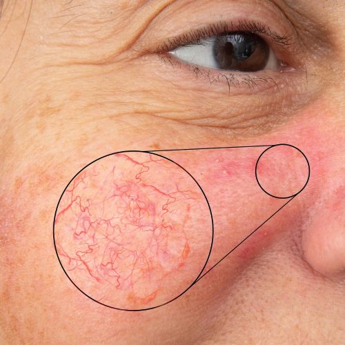 Facial Thread Vein Removal Milton Keynes | Call NOW!