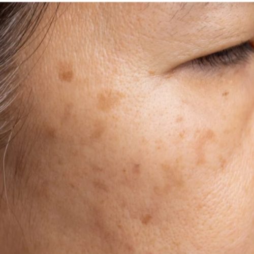 Age Spot Removal in Milton Keynes | Call 770-383-0047