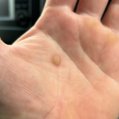 Best Wart Removal in Milton Keynes | Trusted Clinic