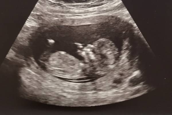 NT Scan in Pune | Best NT Scan Doctors in Pune – Dr. Deepti Mittal