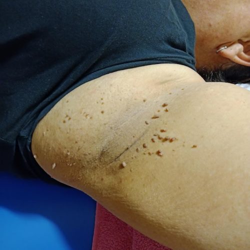 Skin Tag Removal in Milton Keynes | CALL 770-383-0047