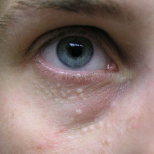 Syringoma Removal Treatment | AH Advanced Skin Specialist