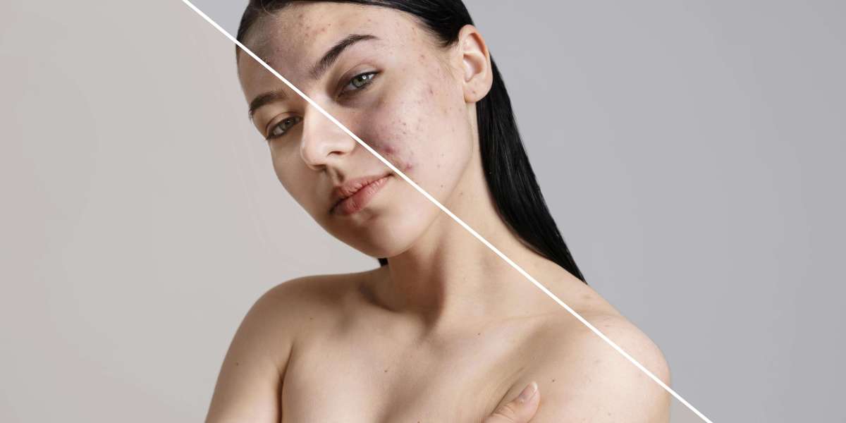 Mistakes That Make Acne Worse