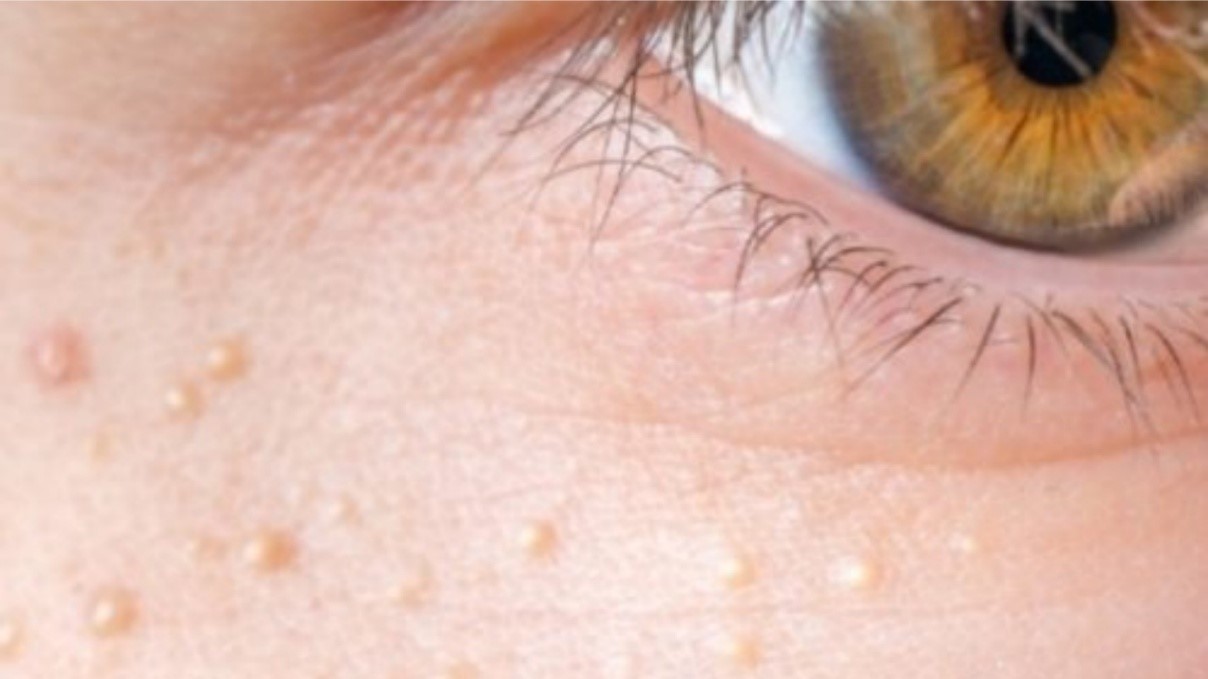When to Get Milia Checked | Signs You Shouldn’t Ignore