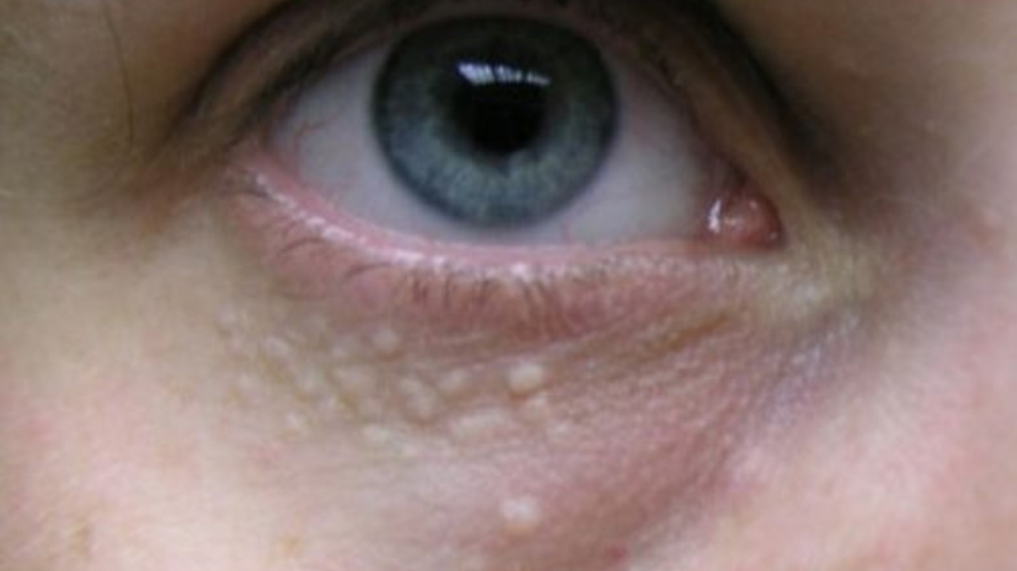 Syringoma Removal Cost | Pricing Guide and Treatment Info
