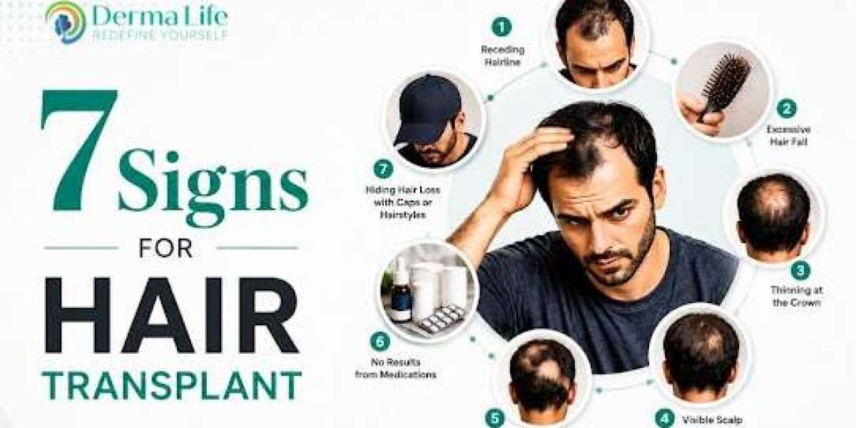 How Many Grafts Do You Need for a Hair Transplant? Complete Graft Calculator Guide for Patients in Delhi, Noida & Gu
