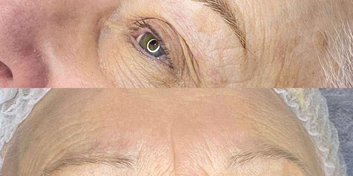 Why Laser Hair Removal Has Become One of the Most Popular Cosmetic Treatments