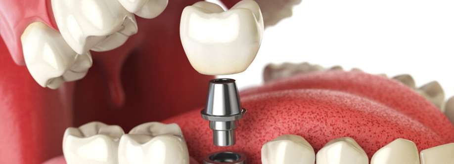 The Cost of Dental Implants Cover Image