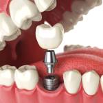 The Cost of Dental Implants Profile Picture